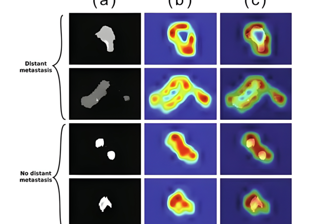AI deep learning in oncological radiomics