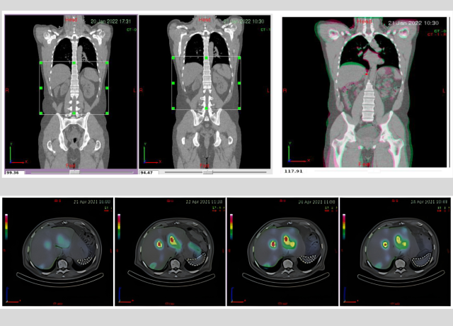 Lu177 dosimetry evaluation