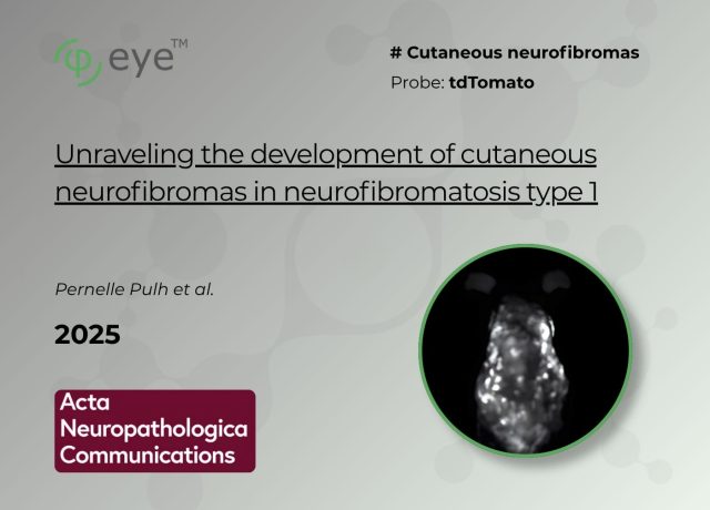 Cutaneous neurofibromas publication